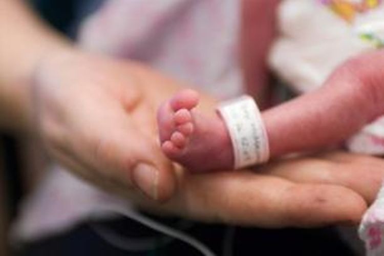 Akibat Kekurangan Gizi, Bayi di Madina Lahir Cacat